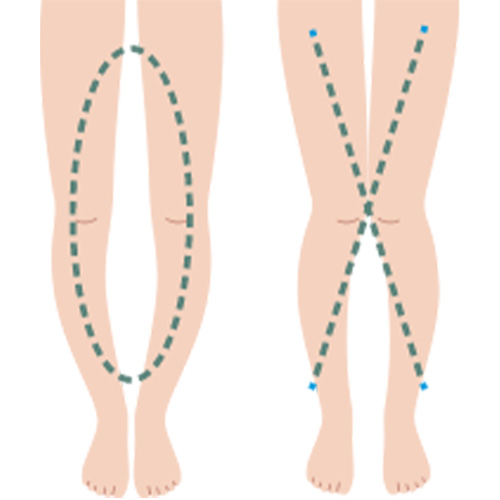 O脚、X脚などの 変形予防