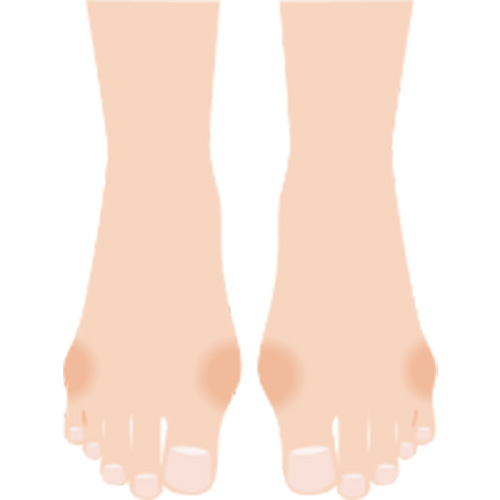 外反母趾、内反小趾